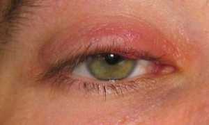 Лечение ячменя с помощью народной медицины, противопоказания