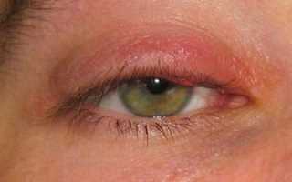 Лечение ячменя с помощью народной медицины, противопоказания