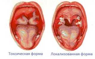 Причины и механизм развития токсической кардиомиопатии