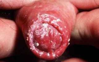 Микротрещины на головке