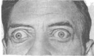 Лечиться ли болезнь выпученных глаз?