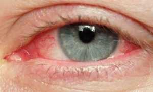 Причины аллергии глаз, симптомы и лечение недуга