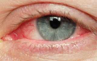 Причины аллергии глаз, симптомы и лечение недуга