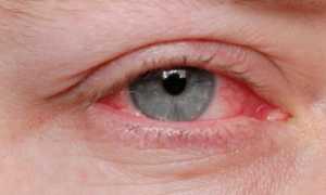 Как вылечить вскрывшийся гнойник ячменя?