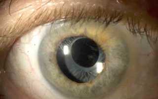 Описание симптомов глаукомы и катаракты, лечение патологий