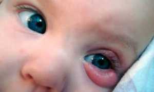 Халязион у ребенка: причины и лечение