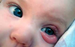 Халязион у ребенка: причины и лечение