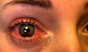 Чем опасно внутриглазное давление? Симптомы патологии