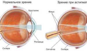 Хрусталиковый астигматизм: лечение, профилактика