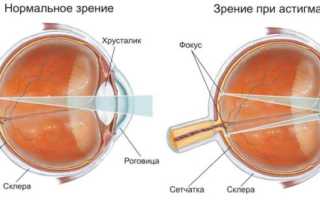 Хрусталиковый астигматизм: лечение, профилактика