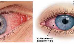 Лечение острого конъюнктивита, диагностика патологии