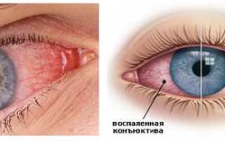Лечение острого конъюнктивита, диагностика патологии