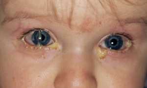 Причины гноящихся глаз у детей