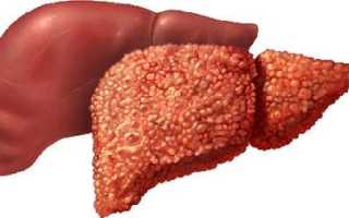 Как вылечить печень после алкогольной интоксикации в домашних условиях