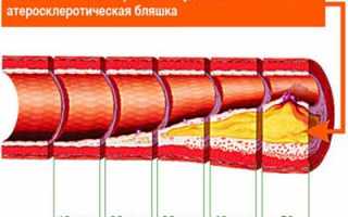 Рецепты для чистки сосудов народными средствами