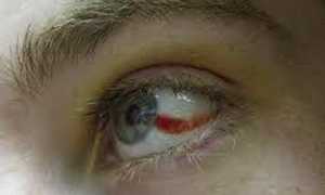 Причины кровоизлияния в глаз и лечение