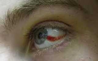 Причины кровоизлияния в глаз и лечение