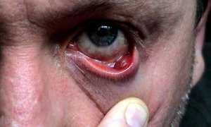 Опасен ли прорвавшийся халязион? Что делать?