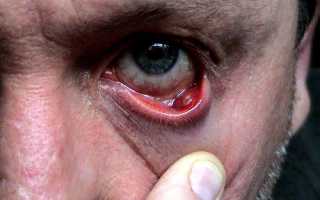 Опасен ли прорвавшийся халязион? Что делать?