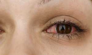 Причины появления инфекционного конъюнктивита и его лечение