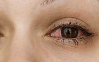 Причины появления инфекционного конъюнктивита и его лечение