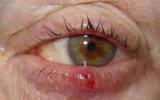 Что делать если нарывает ячмень, меры лечения