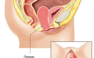 Опущение задней стенки матки упражнения