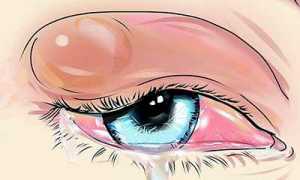 Как проявляется холодный ячмень и как его лечить?