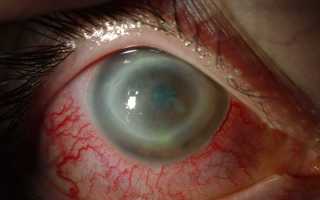 Как лечить акантамебный кератит? Симптомы и последствия