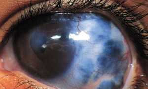 Симптом острого приступа глаукомы, лечение патологии