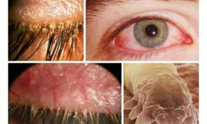 Эффективные мази для лечения демодекоза