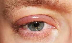 Блефарит, что это?