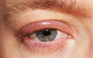 Блефарит, что это?