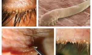 Демодекоз у человека: что вызывает патологию