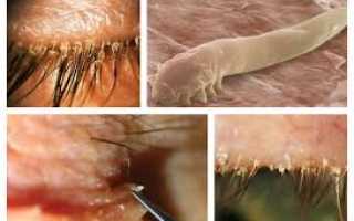 Демодекоз у человека: что вызывает патологию