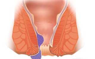 Как устранить каловую пробку