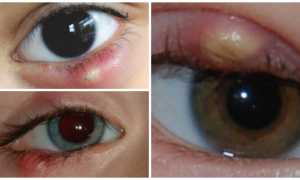 Причины появления халязиона