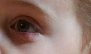 Как вылечить халязион у ребенка?