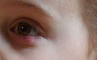 Как вылечить халязион у ребенка?
