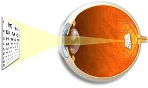 Что такое эмметропия? Лечение и профилактика заболевания