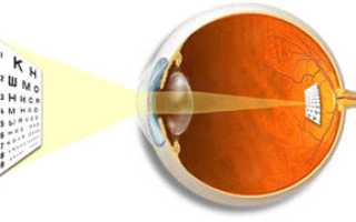 Что такое эмметропия? Лечение и профилактика заболевания