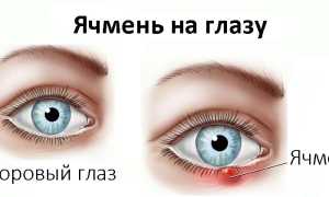 Эффективные лекарства, растворы и мази от ячменя