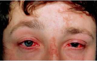 Степени ожога сетчатки глаза