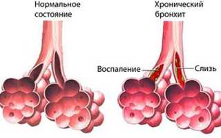 Симптомы и первая помощь при передозировке амоксициллина