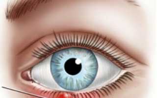 Диагностика внутреннего ячменя, симптомы и лечение