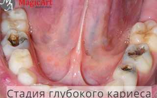 Что будет, если вовремя не вылечить зуб