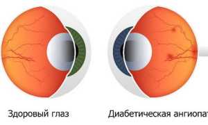 Лечение ангиопатии