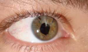 Регматогенная отслойка сетчатки