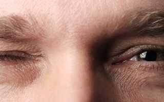 Первые признаки герпеса на веке