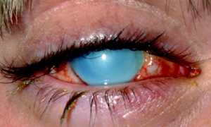 Виды ожогов глаз и лечение